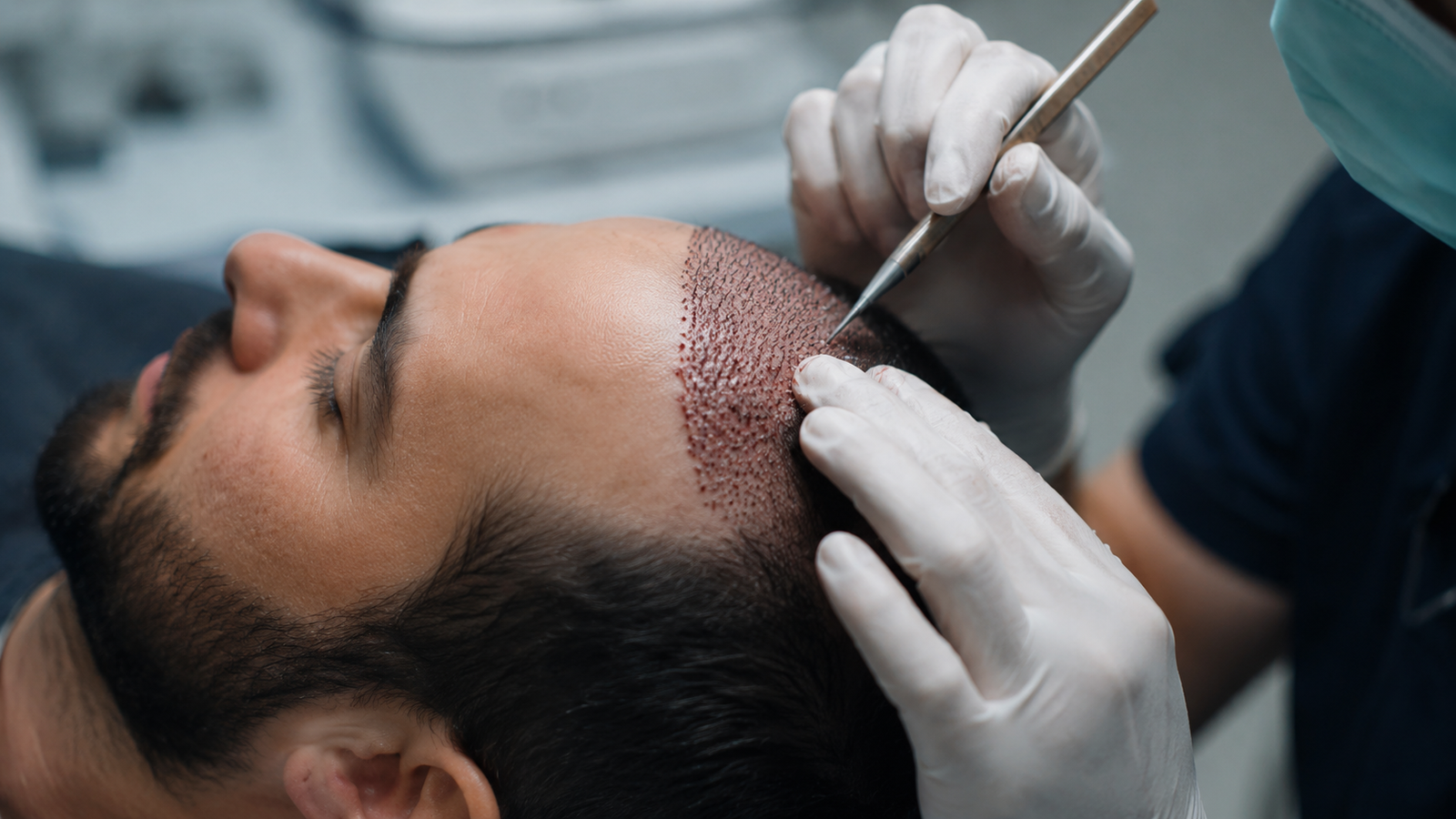 Hair Transplantation